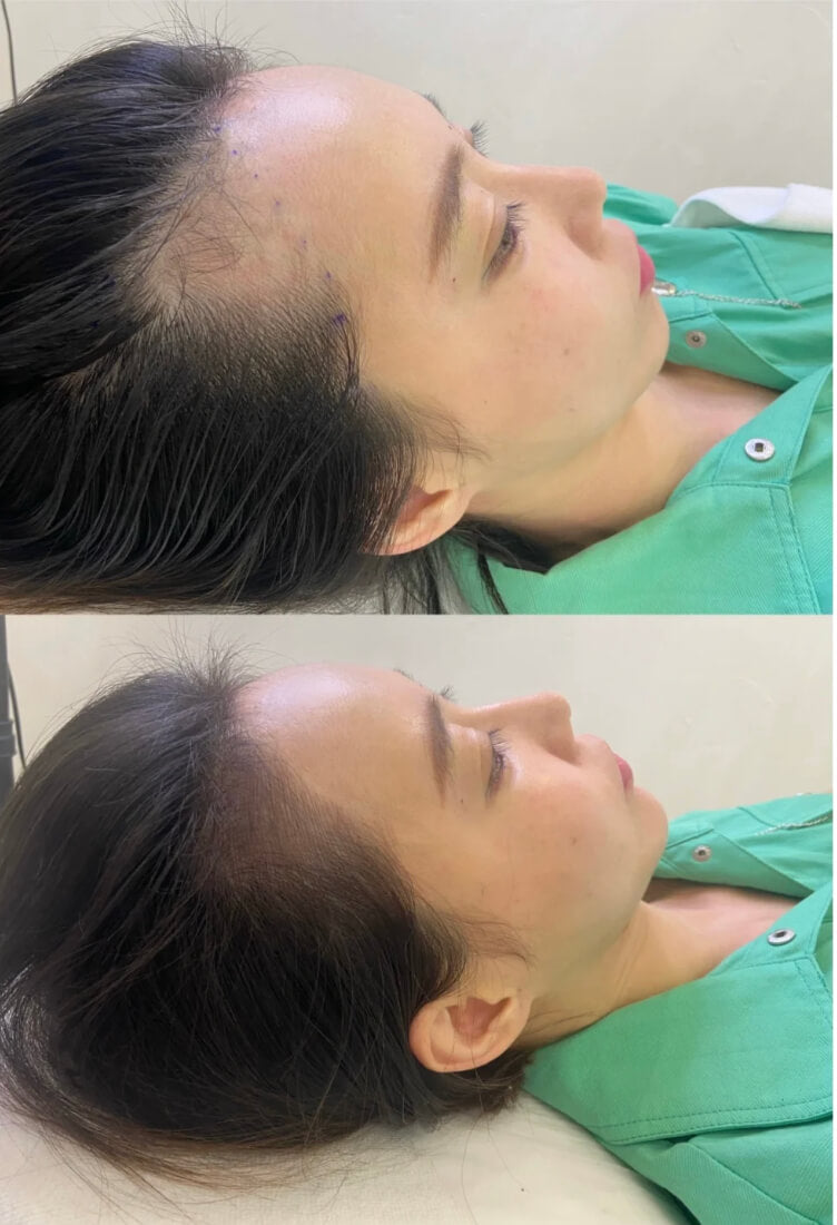 Signature Hair Line 独家发际线